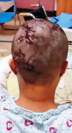 謝女被毆打關在冰櫃內，獲釋後送醫，頭部縫了一百多針。（東森新聞提供）