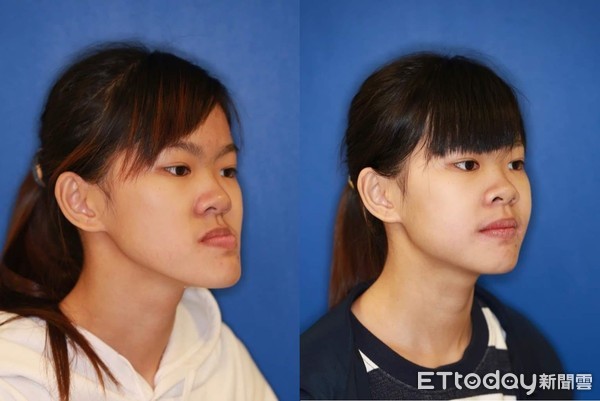 ▲▼戽斗妹。（圖／彰化基督教醫院提供）