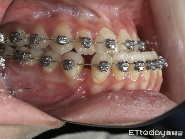 ▲▼戽斗妹。（圖／彰化基督教醫院提供）