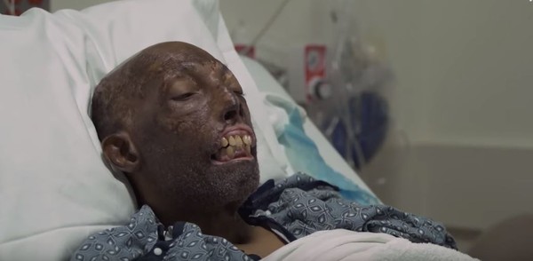 ▲▼68歲黑人羅伯特（Robert Chelsea）臉部移植手術成功。（圖／翻攝自YouTube／WCVB Channel 5 Boston）