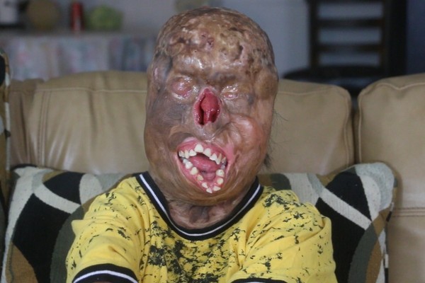 ▲▼美國德州一名16歲少年加西亞（Zaid Garcia）全身四度灼傷，失去雙眼。（圖／翻攝GoFundMe）