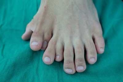 清秀男左脚长9根脚趾 家人拦著不让就医