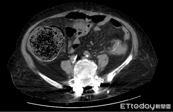 ▲在電腦斷層影像中，可看到婦人大腸後段的降結腸處，有根約3公分、像魚刺般異物。（圖／記者許宥孺翻攝）