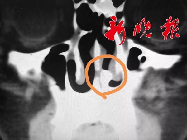 ▲30歲男狂鼻塞...就醫「取出一顆牙齒」　他憶：20年前從4樓墜下。（圖／翻攝新晚報）