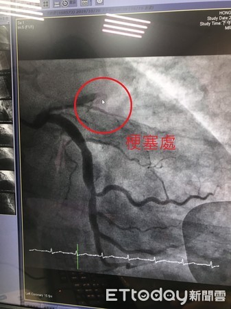 ▲心肌梗塞處。（圖／記者許宥孺攝，下同）