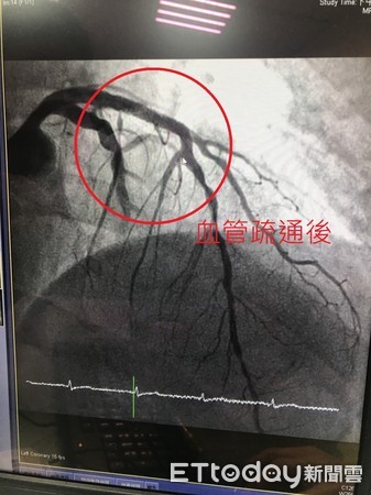 ▲裝設支架後，血管疏通。（圖／記者許宥孺攝）