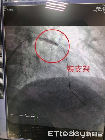 ▲裝設血管支架。（圖／記者許宥孺攝）