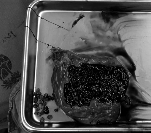 阿公膽囊取出1000顆結石　「黑珍珠」外型網好奇：喝太多珍奶？（圖／翻攝自Facebook／Arak Wongworachat）