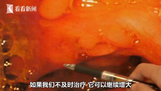 ▲▼56歲男常便血，一查腸道竟長60多顆息肉。（圖／翻攝自看看新聞）