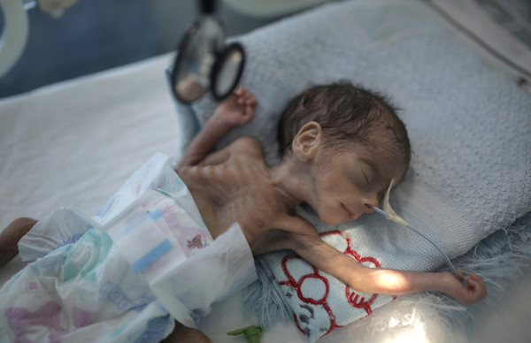 ▲葉門內戰近5年，人道主義危機嚴重。首都沙那（Sanaa）一名男嬰嚴重營養不良。（圖／達志影像／美聯社）