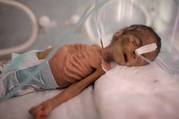 ▲葉門內戰近5年，人道主義危機嚴重。首都沙那（Sanaa）一名男嬰嚴重營養不良。（圖／達志影像／美聯社）