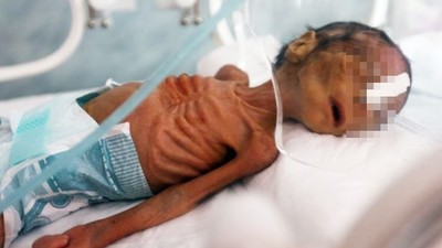 嬰兒瘦到「肋骨眼球外凸」！葉門內戰打五年還不停　飢荒爆發小孩救不完