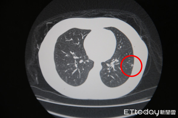 ▲醫生說，低劑量電腦斷層檢查，即使不到1公分大小的腫瘤，也清晰可見。（圖／記者黃孟珍攝）