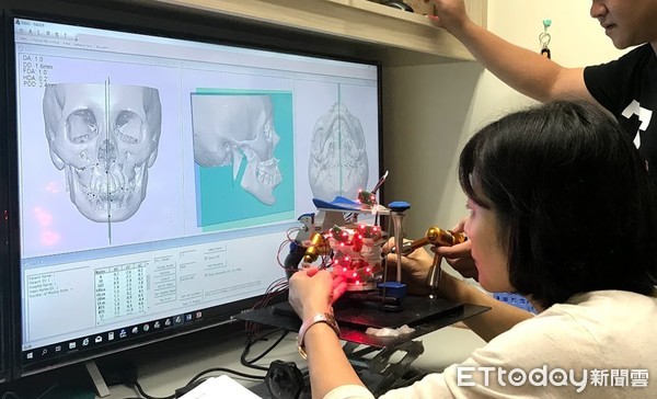▲成大醫院口腔醫學部口腔顎面外科，發展「最佳對稱面程式」，找出最佳對稱面。（圖／成醫提供，下同）