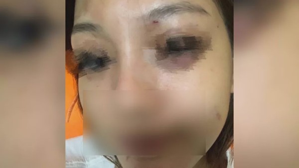 ▲深圳一名王小姐被男友暴打。（圖／翻攝自第一現場，下同）