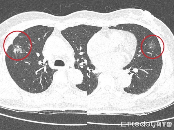兩側肺癌。（圖／台北慈濟醫院提供）