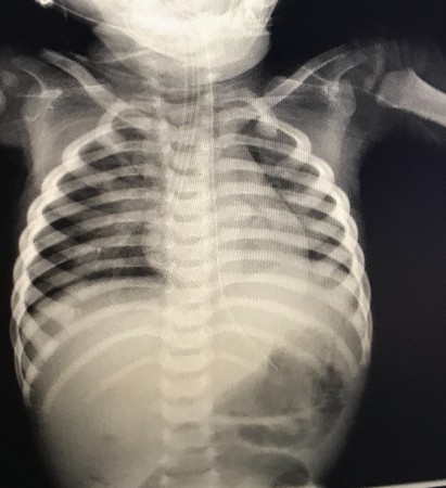 ▲桃園市蘆竹區去年12月28日發生10個月大男嬰疑似受虐，家屬提供醫院拍攝X光照片，顯示胸部多處受傷。（圖／家屬提供）