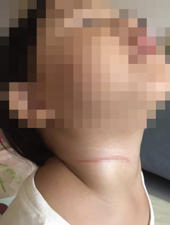 ▲台北市一名家長帶女兒到大湖公園踏青、慘遭風箏線割頸受傷。（圖／翻攝臉書社團）