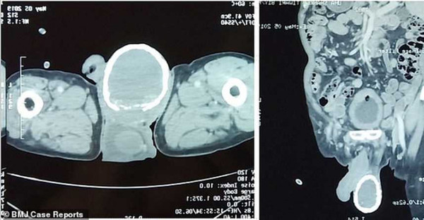 從斷層掃描顯示，患者右陰囊周圍出現鈣化。（圖／翻攝自《英國醫學期刊》）