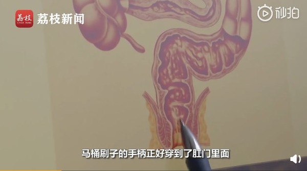 12歲男童洗澡腳滑　「10公分馬桶刷」插破直腸爆痛差點送命！（圖／翻攝自大陸秒拍／JSTV荔枝視頻）