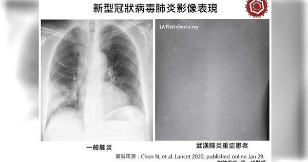武漢肺炎重症患者的X光片(右)，相較於一般肺炎，看來就像隔著一片厚厚的毛玻璃，什麼都看不見。（圖／翻攝醫學期刊《Lancet》）