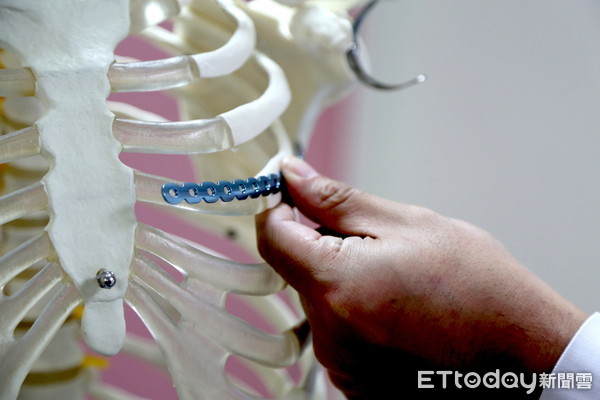 ▲肋骨骨折手術，使用鈦合金的骨板及骨釘精準固定位置，將大大減低患者的疼痛感。（圖／記者黃孟珍攝）