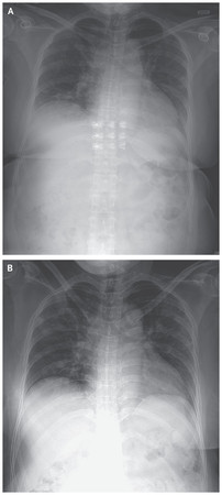 ▲確診病例的肺部X光。（圖／翻攝自《新英格蘭醫學雜誌》）
