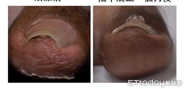 ▲彭賢禮皮膚科診所醫師許嵐表示避免甲溝炎，記得正確剪指甲           。（圖／記者吳奕靖攝）