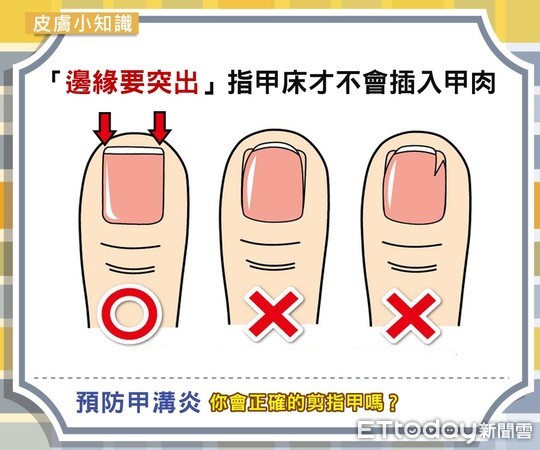 ▲彭賢禮皮膚科診所醫師許嵐表示避免甲溝炎，記得正確剪指甲           。（圖／記者吳奕靖攝）