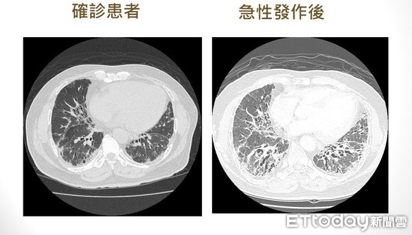 ▲▼常感到喘、咳嗽？當心罹患「菜瓜布肺」影響肺功能               。（圖／記者陳家豪攝）