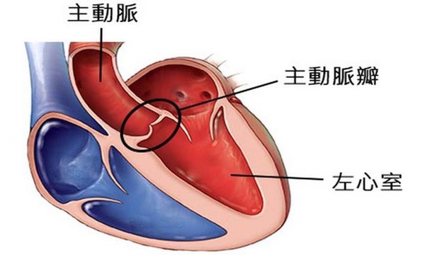 主動脈病變是心臟瓣膜手術常見主因。圖片來源：取自台灣心臟外科研究發展協會