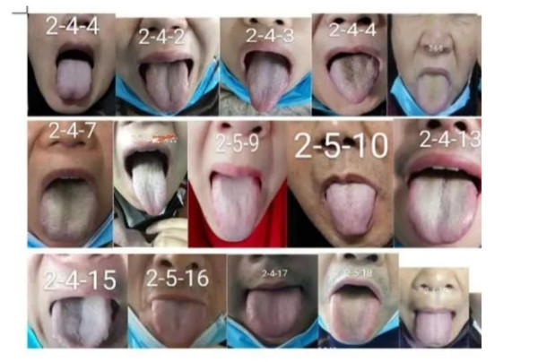 ▲▼女中醫紀錄使用麻黃治療新冠肺炎前後的舌苔變化。（圖／翻攝自微信公眾號：針會天下（acucncom））