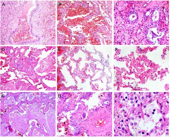 ▲COVID-19肺泡改變活檢。A、壞死性細支氣管炎，腔內可見壞死的支氣管上皮細胞。B、肺泡上皮細胞萎縮。C、細支氣管上皮細胞鱗狀上皮化生。D、肺泡細胞鱗狀上皮化生。E、肺泡隔增厚。F、肺泡上皮細胞壞死、脫屑。G、腔內有炎性細胞和大量纖維素樣滲出物。H、多核鉅細胞。I、肺泡上皮細胞胞漿內病毒包涵體。（圖／翻攝自澎湃新聞）