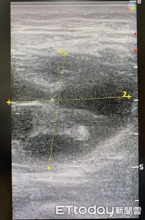 ▲超音波檢查顯示大腿前側肌肉有肌肉斷裂及積液之情形。（圖／記者許宥孺翻攝）