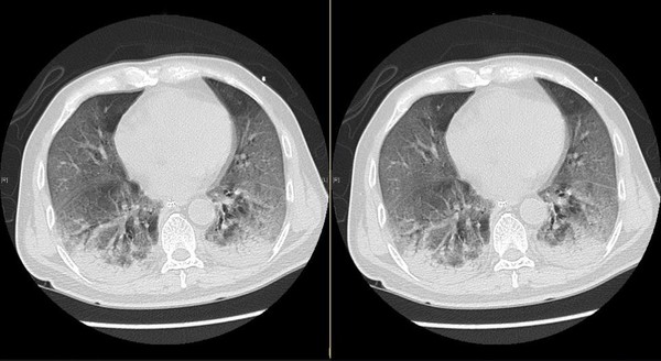 ▲新冠肺炎患者肺部電腦掃描影像。（圖／香港醫管局，下同）