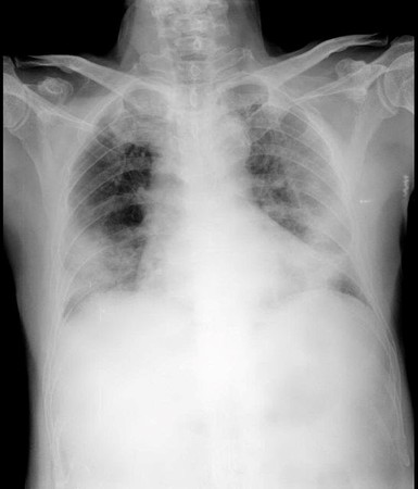 ▲新冠肺炎患者肺部電腦掃描影像。（圖／香港醫管局，下同）