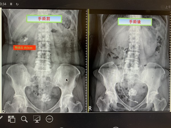 ▲▼腎結石。（圖／中國醫藥大學新竹附設醫院提供）
