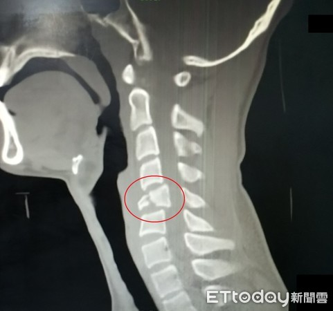 ▲李世祥主任表示，男學生到院時第5頸椎骨折、頸椎脊髓神經損傷、4肢完全癱瘓且麻木。（圖／記者黃孟珍翻攝）