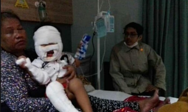 3歲童手拿「消毒液瓶」靠近火源　殘留酒精引火上身嚴重燒傷。（圖／翻攝自Facebook／Kiki Henky Gunawan）