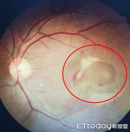▲左眼出現嚴重的黃斑部下出血與視網膜出血。（圖／記者許宥孺翻攝）