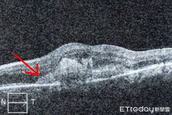 ▲黃斑部附近出現嚴重水腫與黃斑部下方緻密厚度的血塊聚集。（圖／記者許宥孺翻攝）