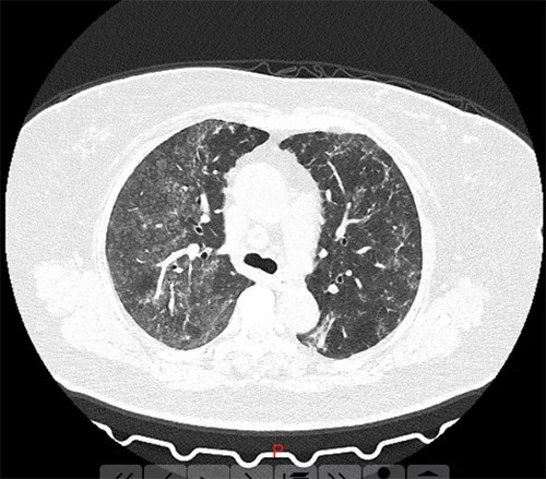 肺炎 ct