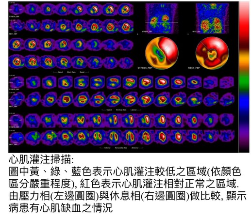 ▲冠狀動脈心臟病、癌細胞轉移　「核醫掃描」對治療有大幫助。（圖／中醫大提供）