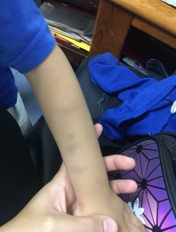 ▲▼幼童遭教師不當體罰 。（圖／人本教育基金會提供）