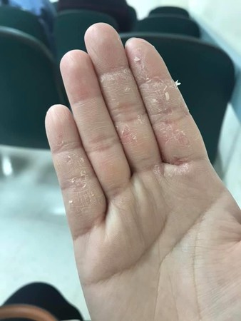 ▲▼ 醫護乾裂手            。（圖／翻攝自Facebook／海巡署長室）