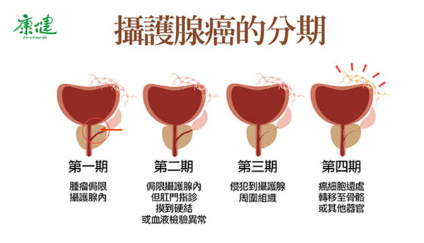 【前監察院長王建煊罹癌】攝護腺癌分1到4期　存活率與治療方式一次說分明