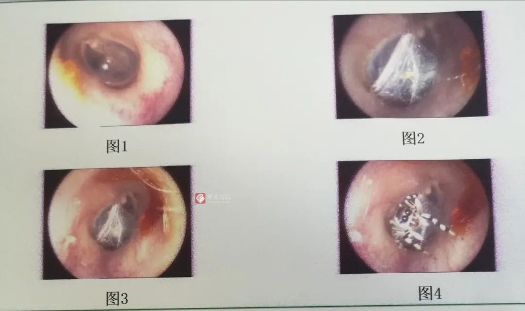 她耳鳴一周就醫！醫檢查傻眼「蜘蛛結網安家」　光一照還到處亂爬。（圖／翻攝《綿陽晚報》）