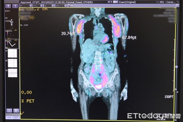 ▲86歲的吳阿嬤，7年前發現腋下腫大，就醫檢查發現是罹患罕見惡性淋巴癌「被套性細胞淋巴瘤」。（圖／慈濟醫學中心提供，下同）