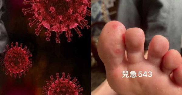 醫界發現新冠肺炎會引起「COVID腳趾」，另外美國傳出腦中風案例。（圖／Pixabay、臉書粉專「來講兒科急診的543-吳昌騰醫師」）