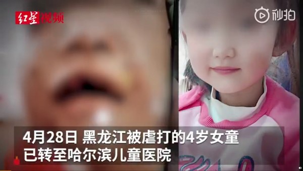 ▲黑龍江4歲女童被虐打。（圖／翻攝自微博）